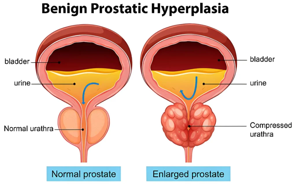 7 Warning Signs of an Enlarged Prostate (BPH)