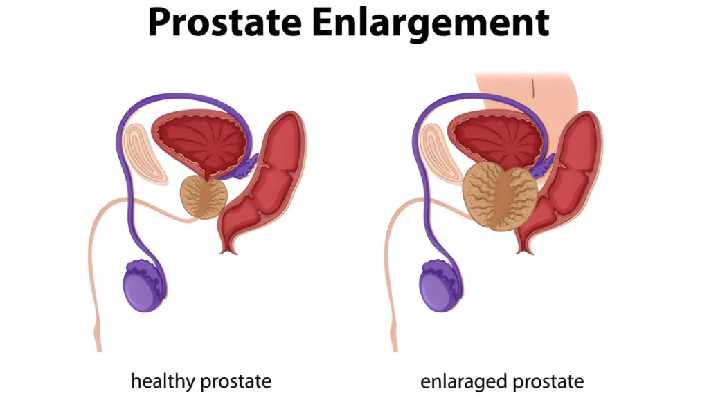 Best Drinks for Enlarged Prostate After 40 2 Common Symptoms of Enlarged Prostate