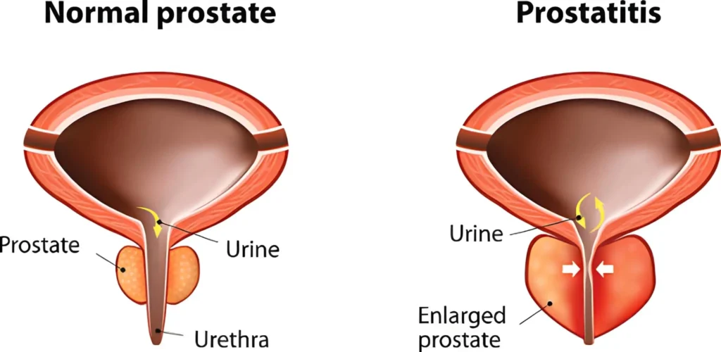 Improve Prostate Health Naturally After Age 40